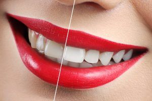 Diseño de sonrisa