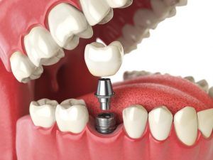 implantes de carga inmediata