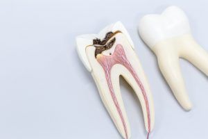necrosis dental
