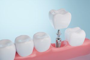 rechazo implante dental