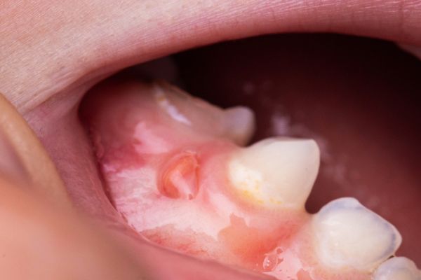 enfermedades periodontales