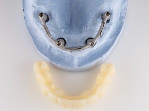 Implantes dentales de carga inmediata
