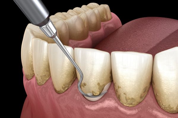 periodoncia