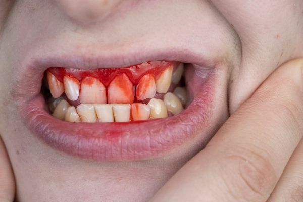 enfermedades periodontales