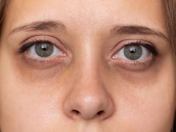 ojeras
