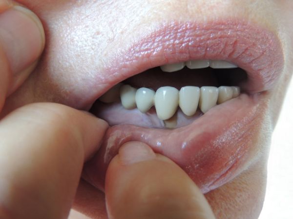 periodontitis